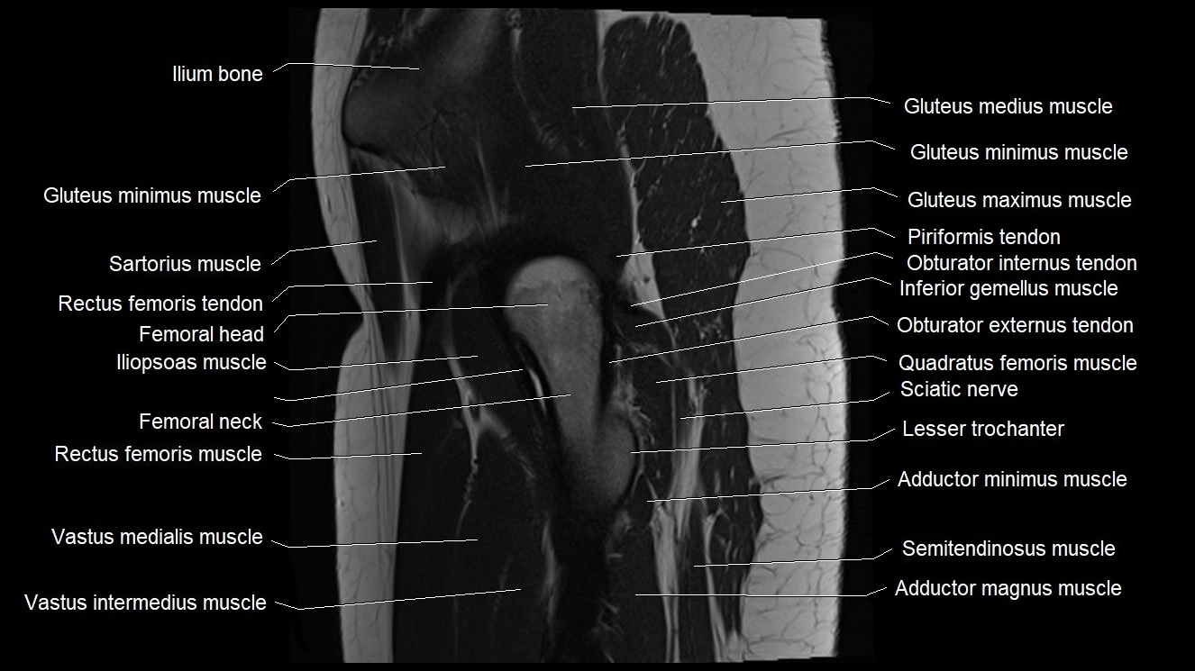 Hip sagittal cross sectional anatomy image 15.webp